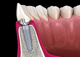 Side view of dental implant successfully integrated with surrounding bone