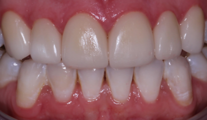 Flawless healthy smile after cosmetic dentistry