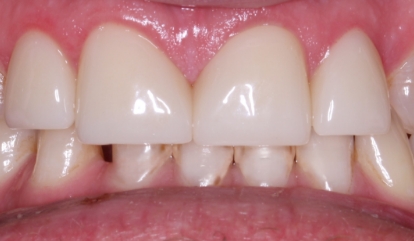 Flawless healthy smile after cosmetic dentistry