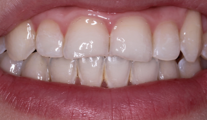 Decayed and damaged smile before cosmetic dentistry