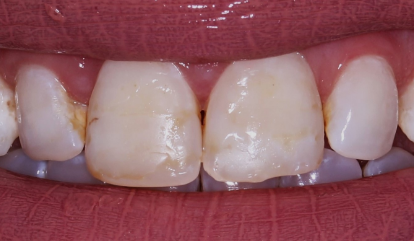 Decayed and damaged smile before cosmetic dentistry