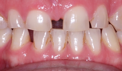 Decayed and damaged smile before cosmetic dentistry