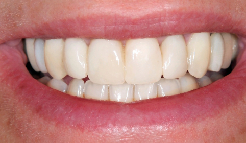 Flawless healthy smile after cosmetic dentistry