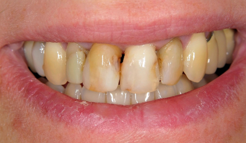 Decayed and damaged smile before cosmetic dentistry