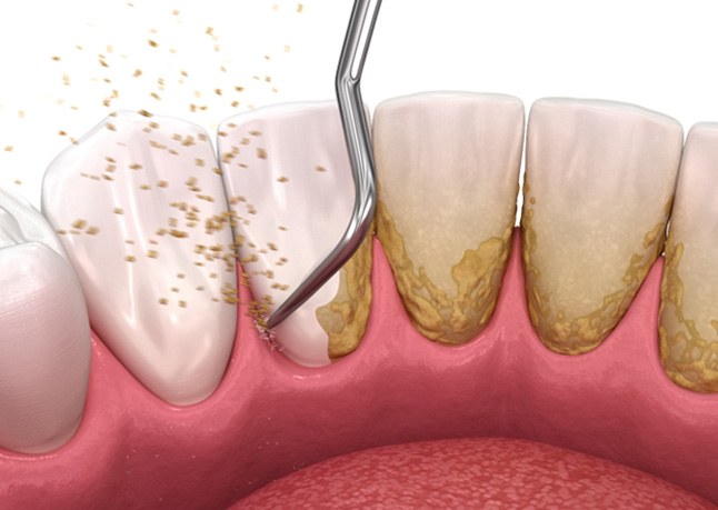 Illustration of tool being used to scale teeth