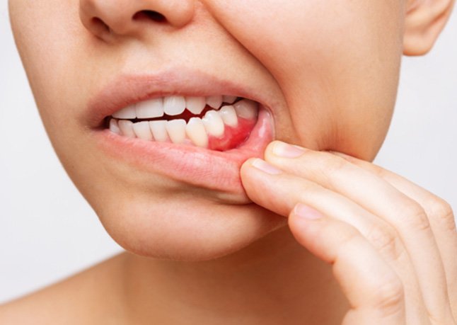 Woman’s red gums, indicative of the need for a deep cleaning