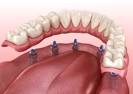 3D image of implant dentures