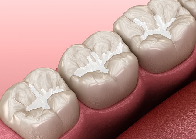 Illustration of three teeth with tooth-colored fillings with pink background