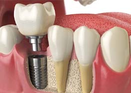 anatomy of dental implant in Rome