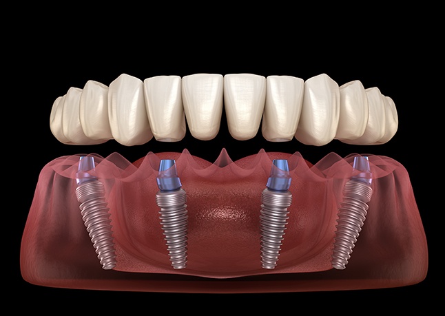 Digital image of implant dentures using dental implant technology in Rome