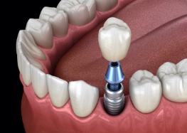 Animated dental implant supported dental crown placement