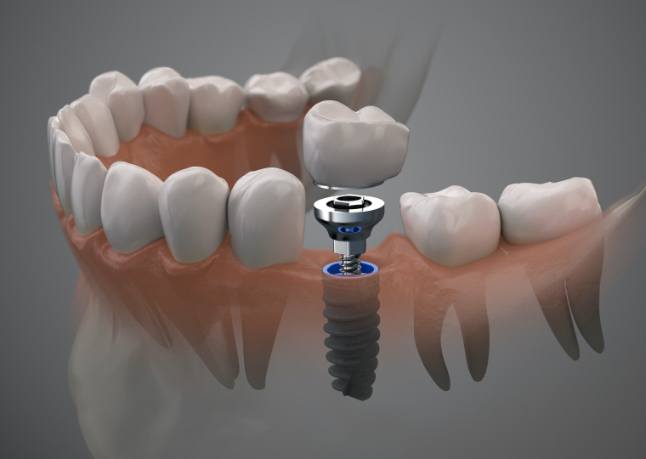 Animated dental implant supported dental crown placement