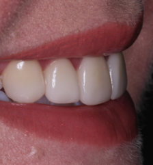 Flawless healthy smile after cosmetic dentistry