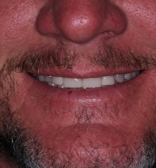 Flawless healthy smile after cosmetic dentistry