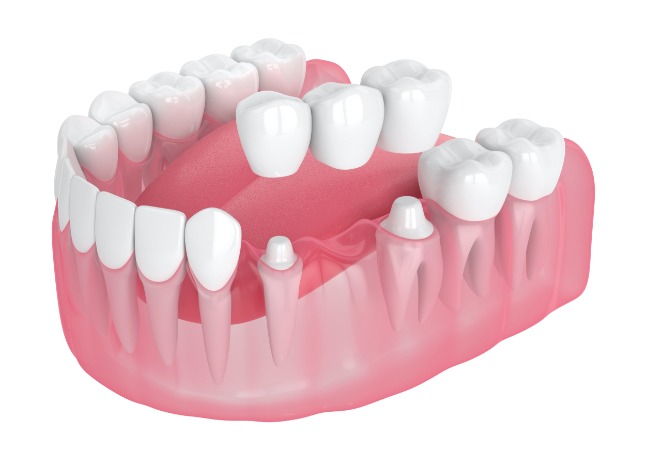 Animated smiling during dental bridge placement to replace missing teeth