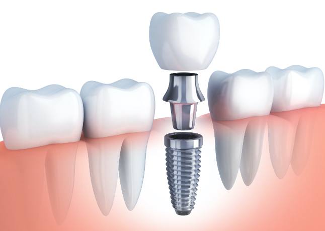 Animated dental implant supported dental crown placement