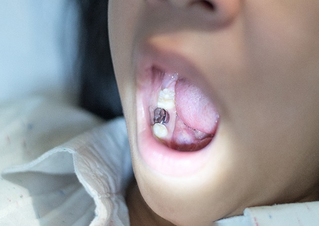 Child with dental crown