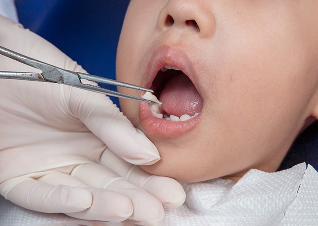 Baby tooth extraction