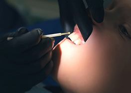 Dentist applying Silver Diamine Fluoride liquid to a child's tooth in Rome 
