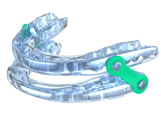 Close-up of oral appliance for treating sleep apnea