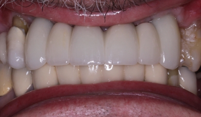 Flawless healthy smile after cosmetic dentistry
