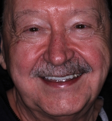 Flawless healthy smile after cosmetic dentistry
