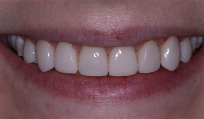 Flawless healthy smile after cosmetic dentistry