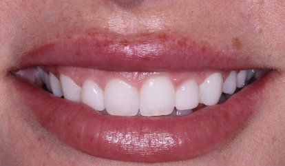 Flawless healthy smile after cosmetic dentistry