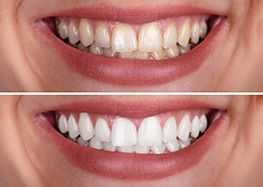 before-and-after teeth whitening closeup of a mouth