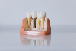 Model of a single dental implant